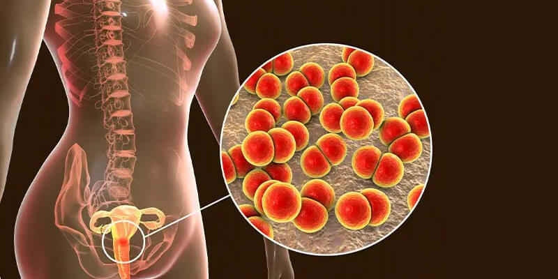 Image representing symptoms or impact of Gonorrhea infection